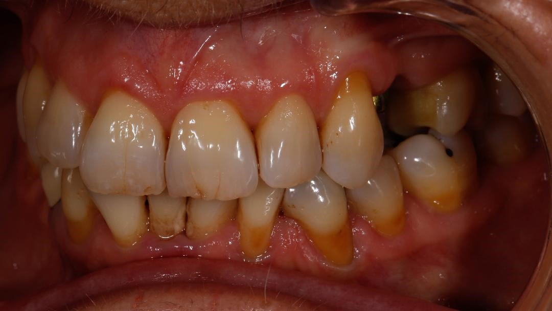 University Dental Practice - Implant - Pre op 3