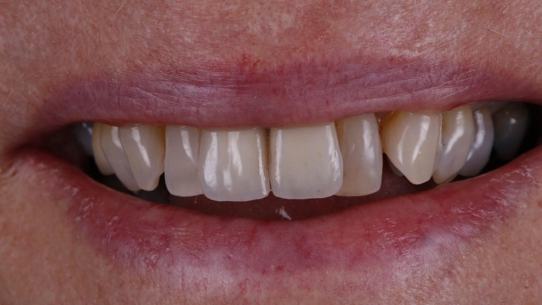 University Dental Practice - Implant - Post op 2