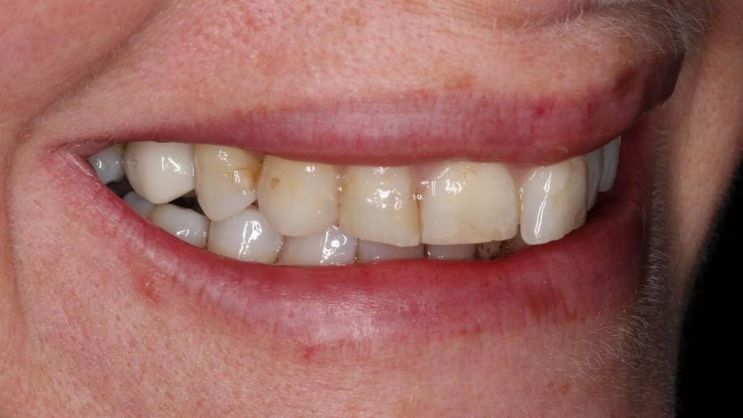 University Dental Practice - Implant - Post op 4