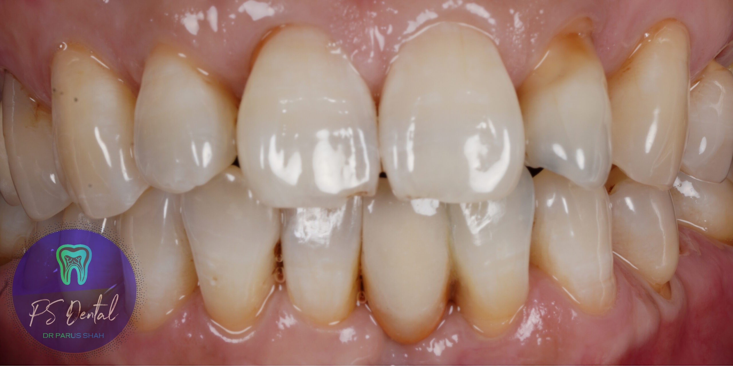 Dental Resin bonded bridge - After Treatment