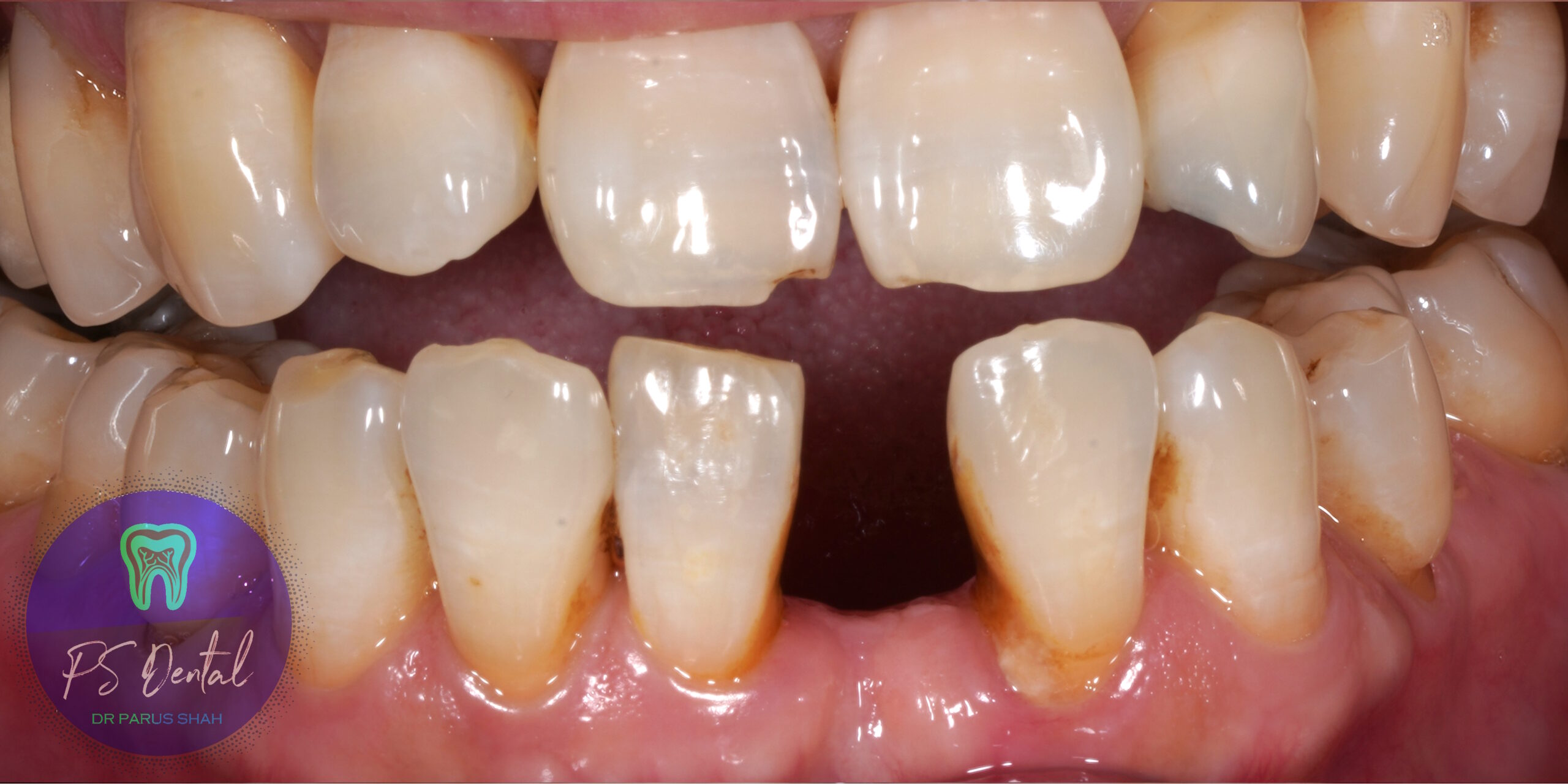 Dental Resin bonded bridge - Before Treatment